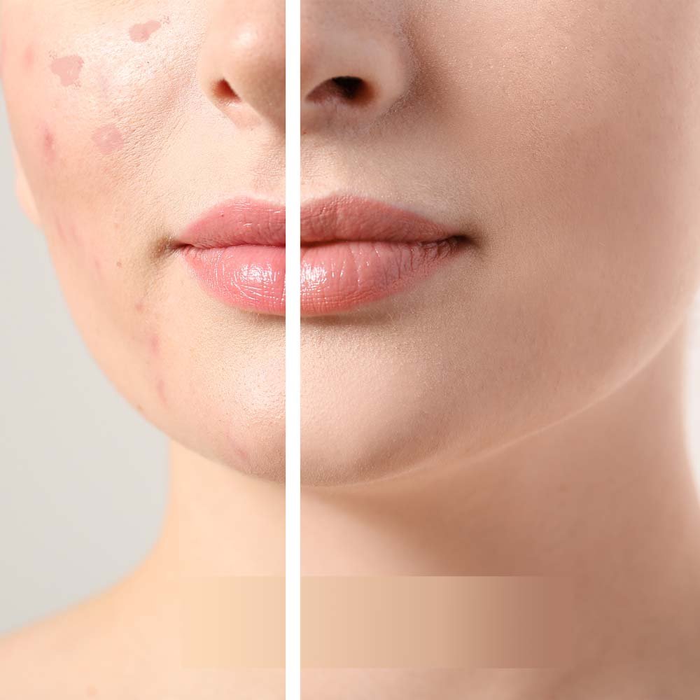 Acne Before & After