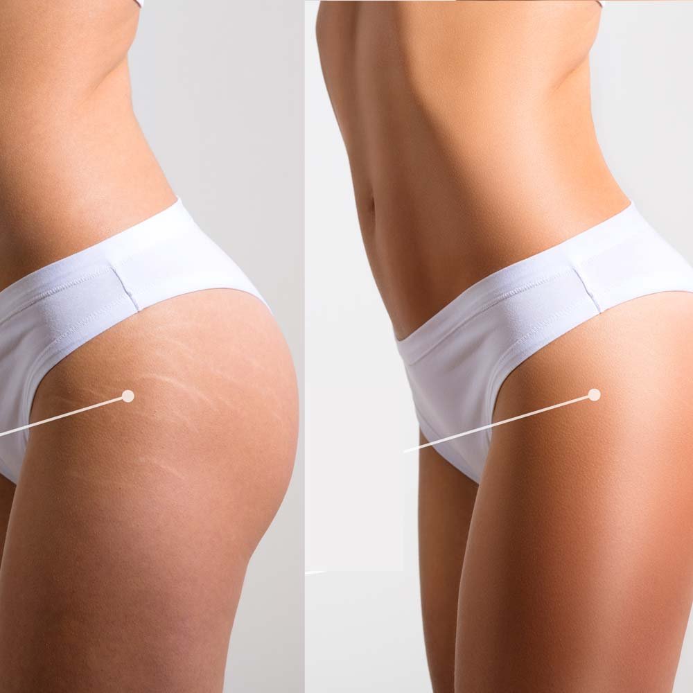 Stretch Marks BEFORE & AFTER